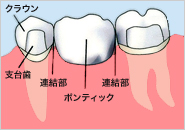 クラウン 支台歯 連結部 ボンティック 連結部