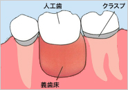 人工歯 スクラブ 義歯床