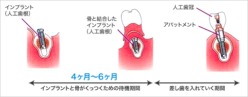 インプラント（人工歯根）骨と結合した インプラント （人工歯根）人工歯冠 アバットメント 4ヶ月～6ヶ月 インプラントと骨がくっつくための待機期間 差し歯を入れていく期間