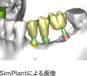 SimPlantによる画像