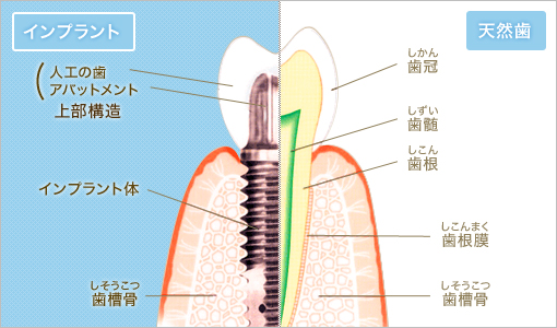 インプラント 人工の歯アバットメント 上部構造 インプラント体 しそうこつ 歯槽骨 天然歯 しかん 歯冠 しずい 歯髄 しこん 歯根 しこんまく 歯根膜 しそうこつ 歯槽骨