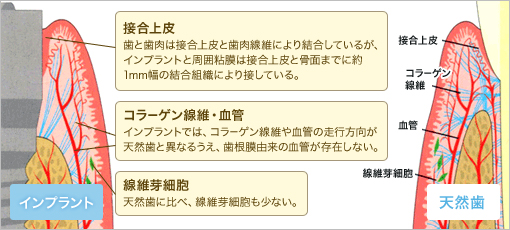 インプラント 接合上皮 歯と歯肉は接合上皮と歯肉線維により結合しているが、インプラントと周囲粘膜は接合上皮と骨面までに約1mm幅の結合組織により接している。 コラーゲン線維・血管 インプラントでは、コラーゲン線維や血管の走行方向が天然歯と異なるうえ、歯根膜由来の血管が存在しない。 線維芽細胞 天然歯に比べ、線維芽細胞も少ない。 接合上皮 コラーゲン 線維 血管 線維芽細胞 天然歯