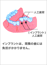 人工歯冠 (インプラント) 人工歯冠 インプラントは、両隣の歯には負担がかかりません。
