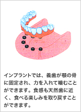 インプラントでは、義歯が顎の骨に固定され、力を入れて噛むことができます。食感も天然歯に近く、食べる楽しみを取り戻すことができます。