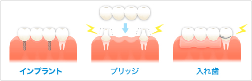 インプラント ブリッジ 入れ歯