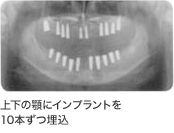 上下の顎にインプラントを 10本ずつ埋込