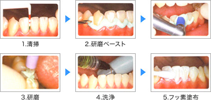 1.清掃 2.研磨ペースト 3.研磨 4.洗浄 5.フッ素塗布