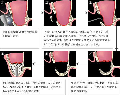 上顎洞側壁骨の相当部の歯肉を切開します。上顎洞の側方の骨を上顎洞の内側には「シュナイダー膜」と呼ばれる非常に薄い粘膜上皮が覆っており、それを剥がしていきます。最近はこの時により安全に処置のできるピエゾと呼ばれる最新の機械も出てきています。その隙間に骨となるもの（自分の骨か、人口の骨のもととなるもの）を入れて、それが固まる（骨ができあがる）のを4～6カ月待ちます。 骨窓を下から内側に押し上げて上顎洞底部の粘膜を拳上し、上顎の骨との間に隙間を作ります。