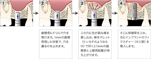 歯槽骨にドリルで穴を開けます。1mmの歯槽骨残した状態で、穴を掘るのを止めます。 この穴に先が鈍な棒を差し込み、棒をマレット（トンカチのようなもの）で叩くと1mmの歯槽骨と上顎洞粘膜が持ち上がります。 そこに移植骨を入れ、次にインプラントのフィクスチャー（ネジ部）を埋入します。