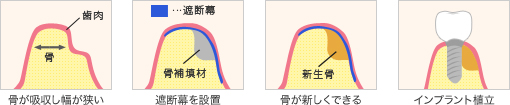 骨が吸収し幅が狭い 遮断幕を設置 骨が新しくできる インプラント植立