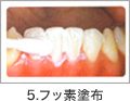 5.フッ素塗布