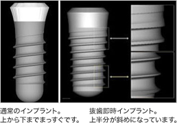 通常のインプラント。上から下までまっすぐです。 抜歯即時インプラント。上半分が斜めになっています。