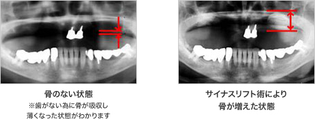 骨のない状態※歯がない為に骨が吸収し薄くなった状態がわかります サイナスリフト術により骨が増えた状態