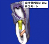 歯槽骨断面方向に 断面カット