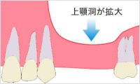 上顎洞が拡大