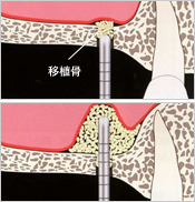 移植骨